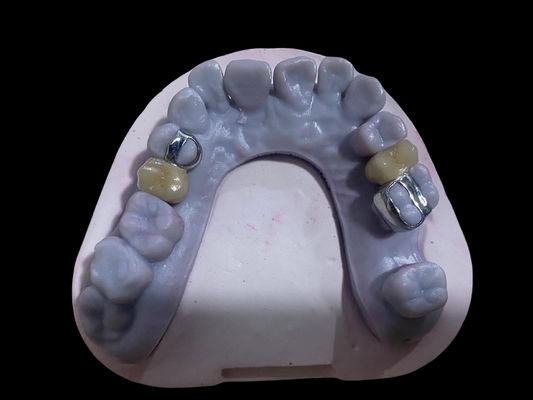 comprar Coroas de porcelana de metal livre de liga dentária de coroa PFM de alta precisão Fabricação em linha