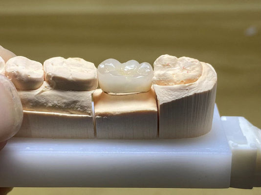 comprar Resistência à mancha PFM coroa cerâmica ajustável com a forma natural do dente Fabricação em linha