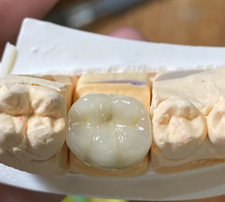 comprar Porcelana PFM Dental Forte e Estética Fusão à Coroa de Metal na Odontologia Fabricação em linha