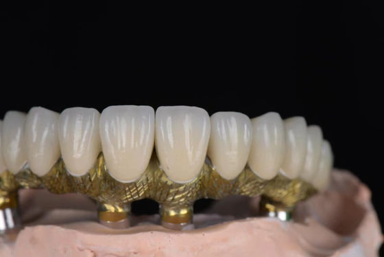 comprar Porcelana de coroa de aparência natural fundida em metal de alta precisão para implantes dentários Fabricação em linha