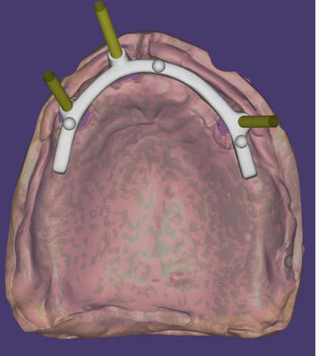 comprar Design Dental CAD CAM personalizado de alta precisão para barra suportada por implante Fabricação em linha