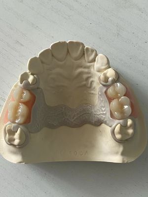 comprar Dental PEEK personalizado Dentadura parcial acrílica ajustável com ajuste seguro Fabricação em linha