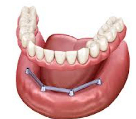 comprar Barras de implante translúcidas retidas por parafuso Dentadura de superfície polida Barras de implante Fabricação em linha