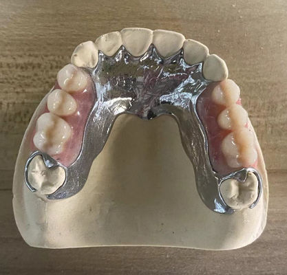 Dentes parciais de metal fundido de alta resistência