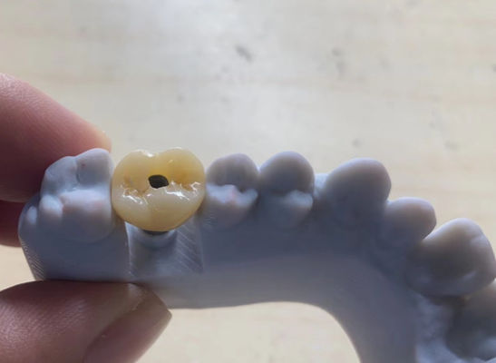 Implante de alta precisão com coroa de suporte estável e fácil de manter