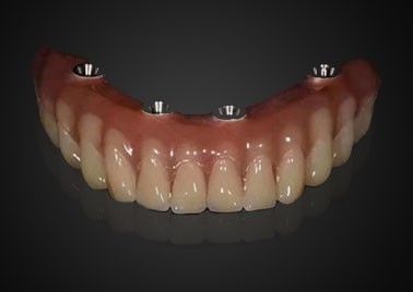 Implante Dental de substituição personalizado resistente ao desgaste para uso a longo prazo