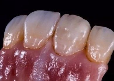 Alemão Amanjilbach Zirconia coroa dental de alta densidade com personalização