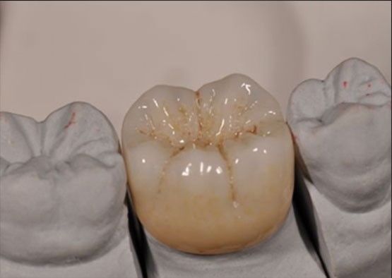Alta estética Noritake Zirconia cor natural estável para coroa completa de zirconia