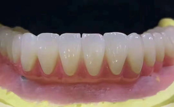 Coroa dentária de zircônia personalizada resistente a manchas com alta precisão