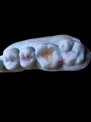 Natural Translúcido Todo Cerâmica Dental Emax Onlay Para Restauração Dental