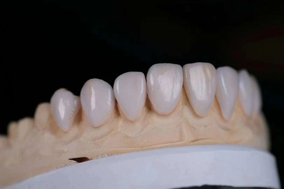 Coronas de laboratório dentário de alta estética porcelana revestida de zircônio resistência à mancha