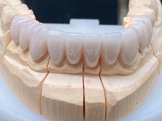 Laboratório Dental E Max Coroa Cerâmica Alta Translúcida com Resistência à Corrosão