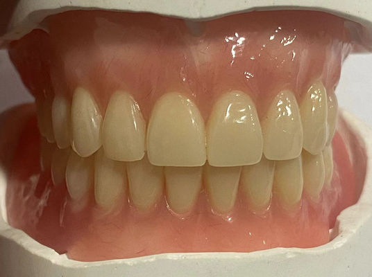 Dentadura parcial removível personalizada hipoalergênica com cor rosa da goma