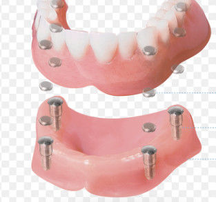 Limpeza de superfície de fixação dentária magnética de alta precisão e personalizável