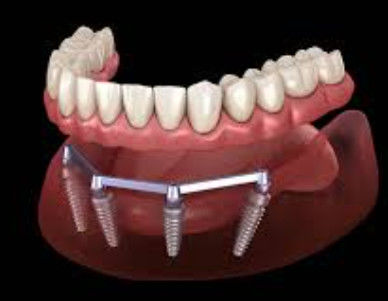 Barras de implante dentário para estética translúcida e natural