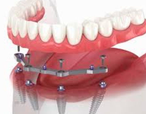 Barras de Titânio de Arco Completo 12 mm de comprimento com 2+ anexos