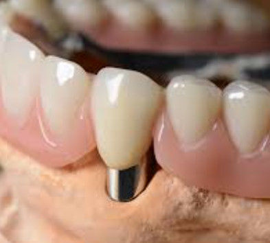 Coroa Dental Telescópica Personalizável de Alta Precisão com Aparência Natural