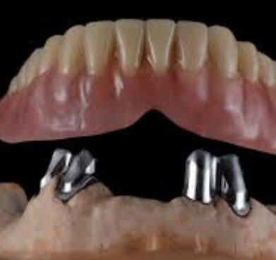Coroas telescópicas confortáveis e de fácil manutenção personalizadas para restauração dentária