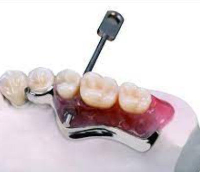 Fácil de instalar chave e porta-chave fixação dentária resistente à oxidação