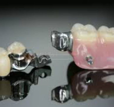 Alta flexibilidade Mk1 fixação dentária alta precisão e segurança de uso